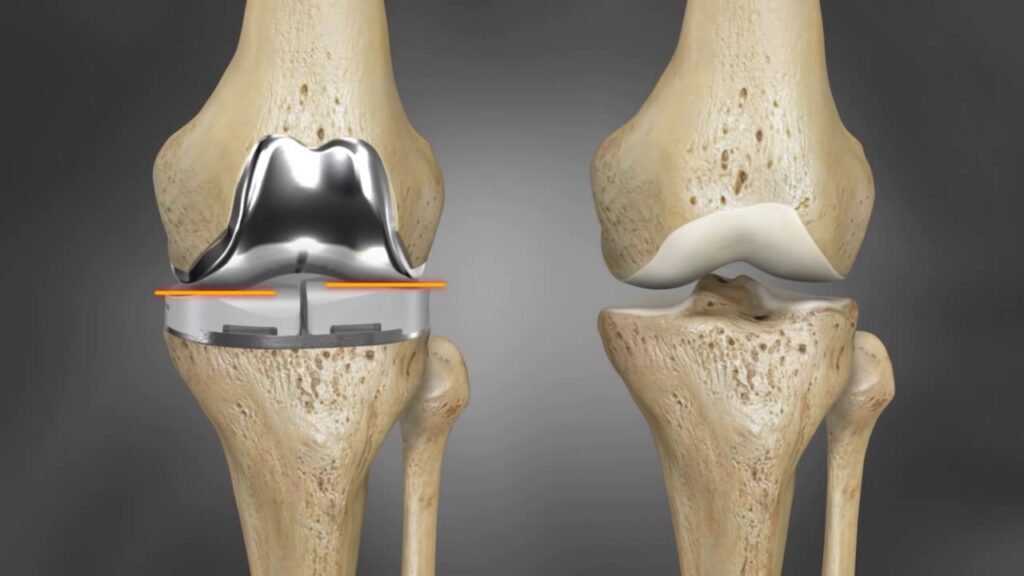 3D Printed Hip and Knee Implants Market