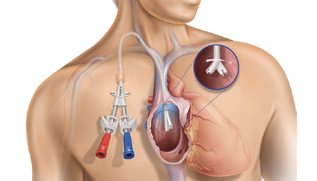 Global Catheter-Related Bloodstream Infection Treatment