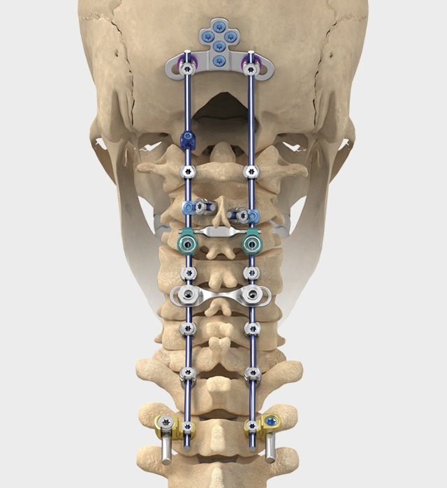 Global Cervical Spacer Systems Industry