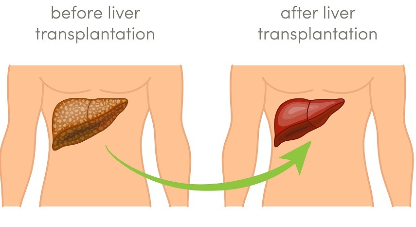 Global Liver Transplantation Market
