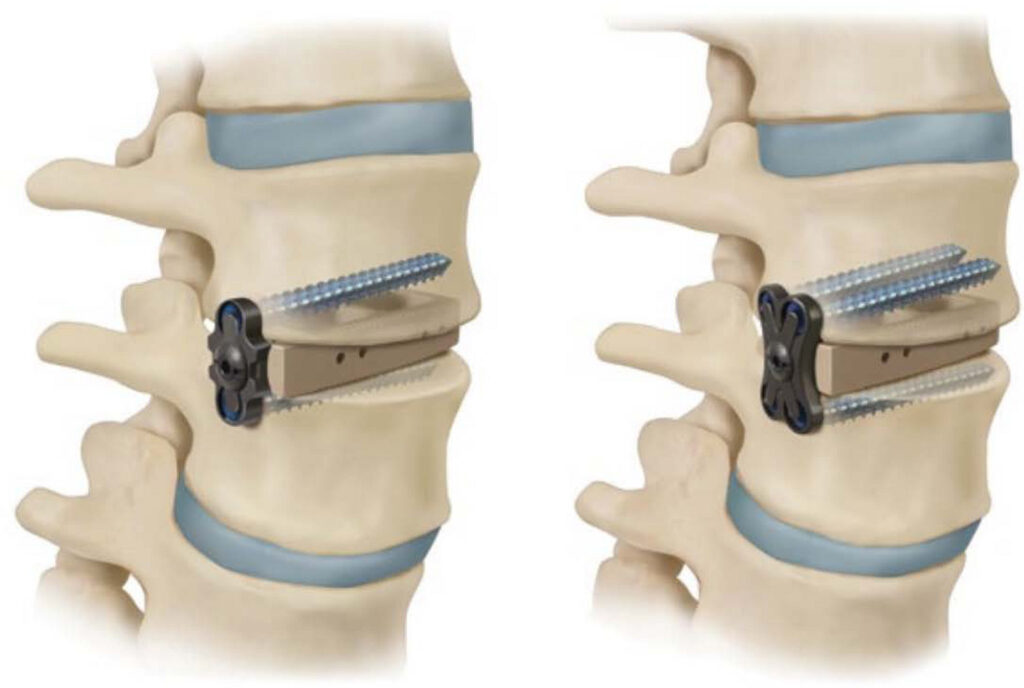 Global Non Fusion Spinal Devices Industry
