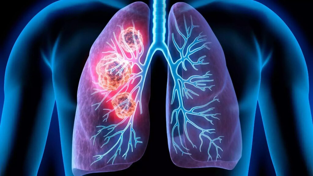 Global Non-Small Cell Lung Carcinoma Industry