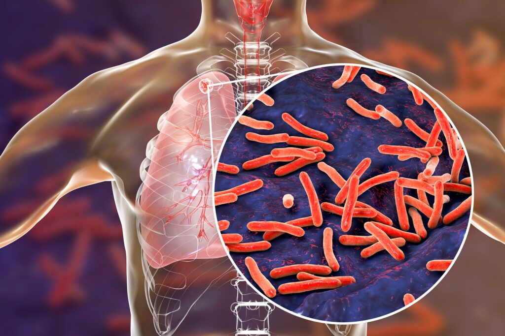 Global Ocular Tuberculosis Therapeutics Industry