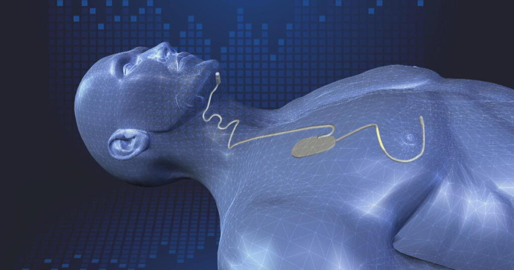 Global Sleep Apnea Implants Industry