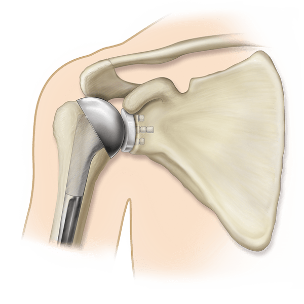 Humeral Implant Market