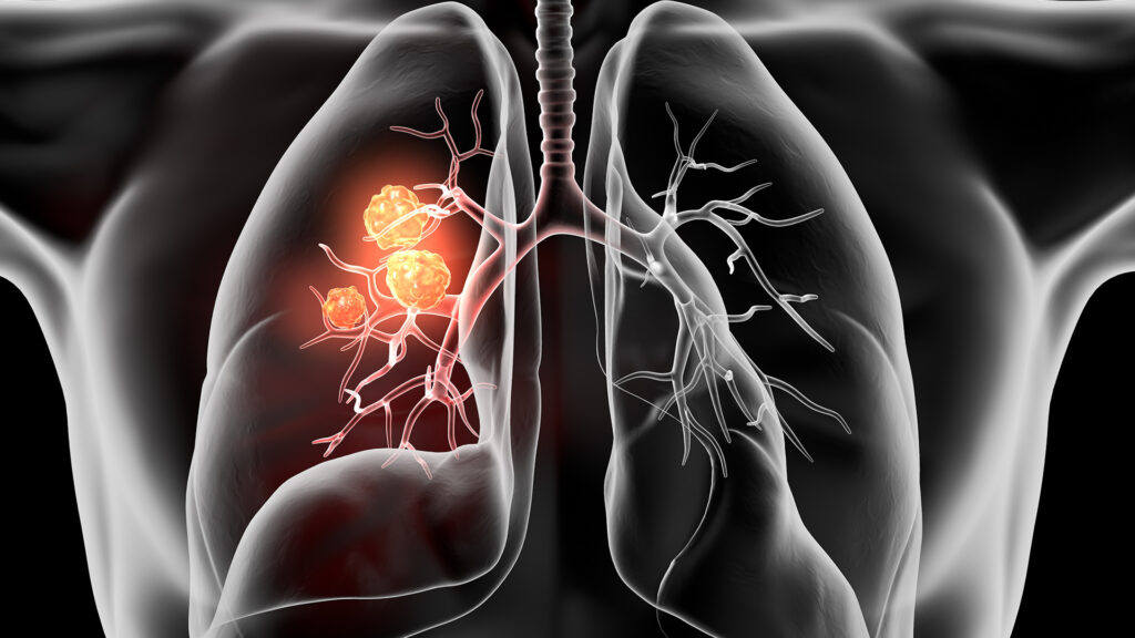 Lung Cancer PCR Panel Market