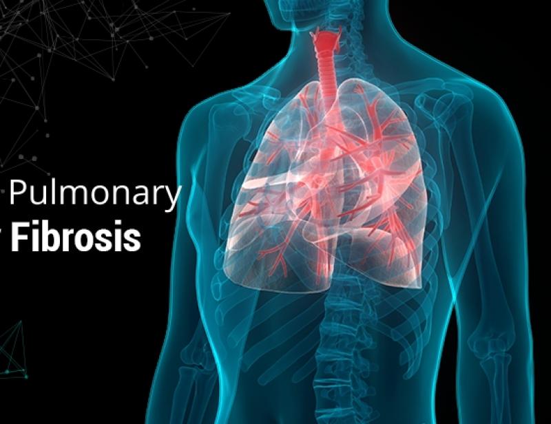 Global Progressive Pulmonary Fibrosis Treatment Industry