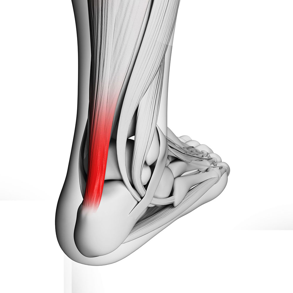 United States Tendonitis Treatment Industry
