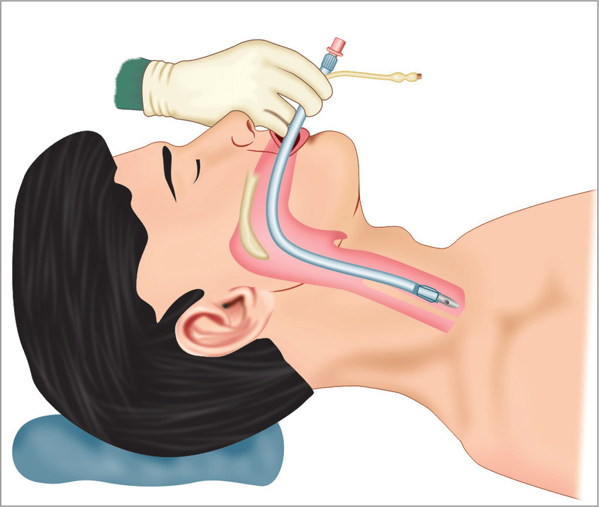 Tracheal Tubes and Airway Products
