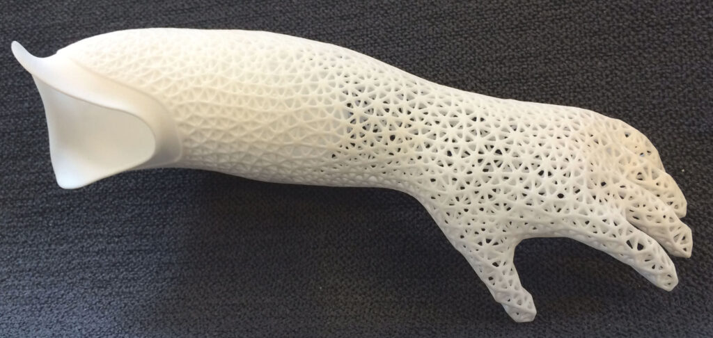 Global 3D Printed Prosthetics Industry