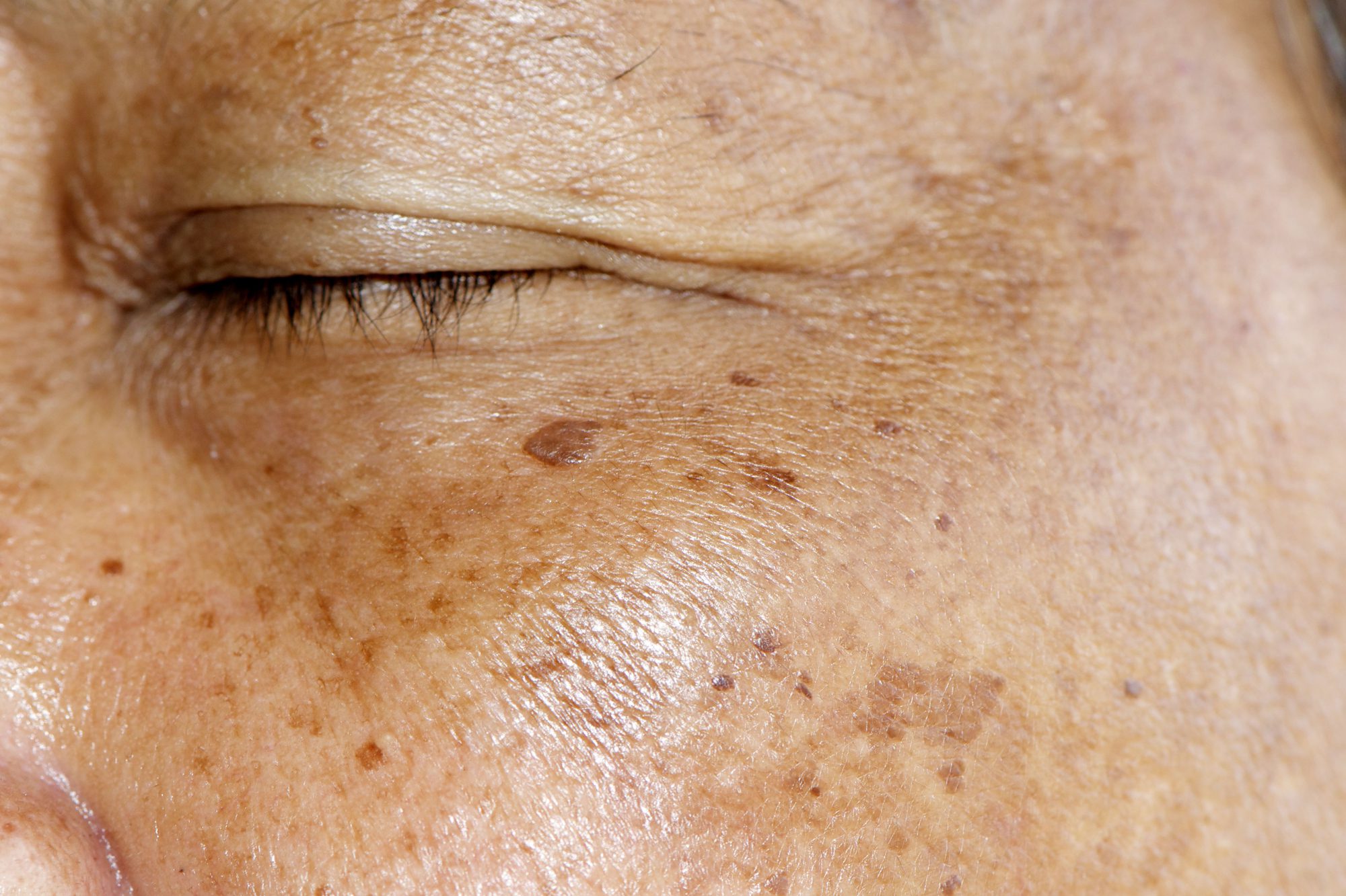 Global Actinic Keratosis Treatment Industry Set To Nearly Double By 2034 Reaching Us1228 7699