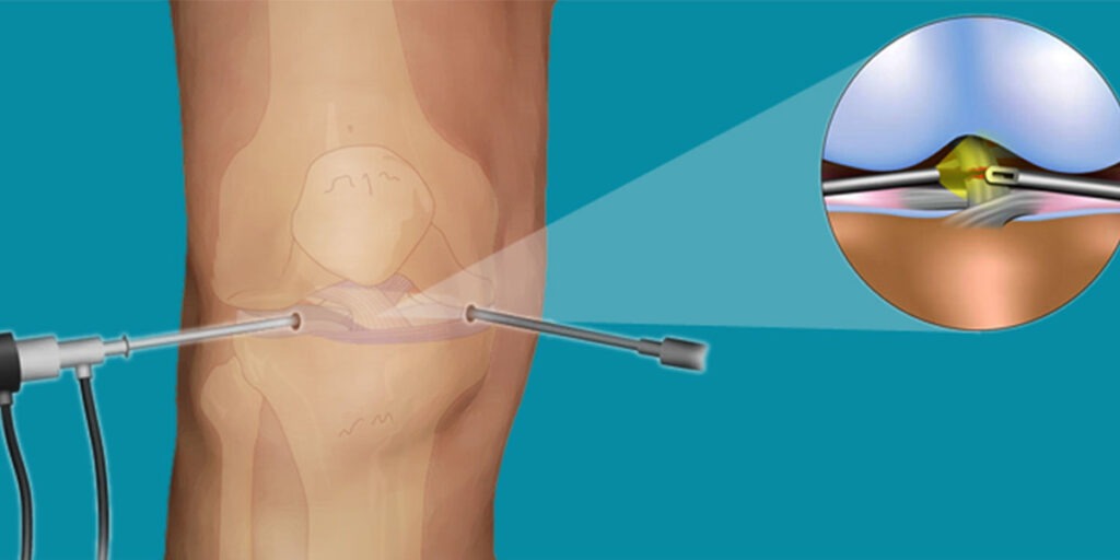 Arthroscopy Devices Market