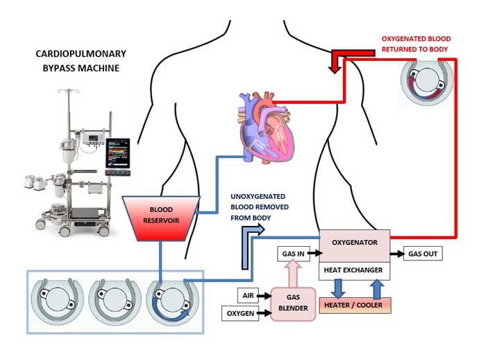Cardiopulmonary Bypass System Market