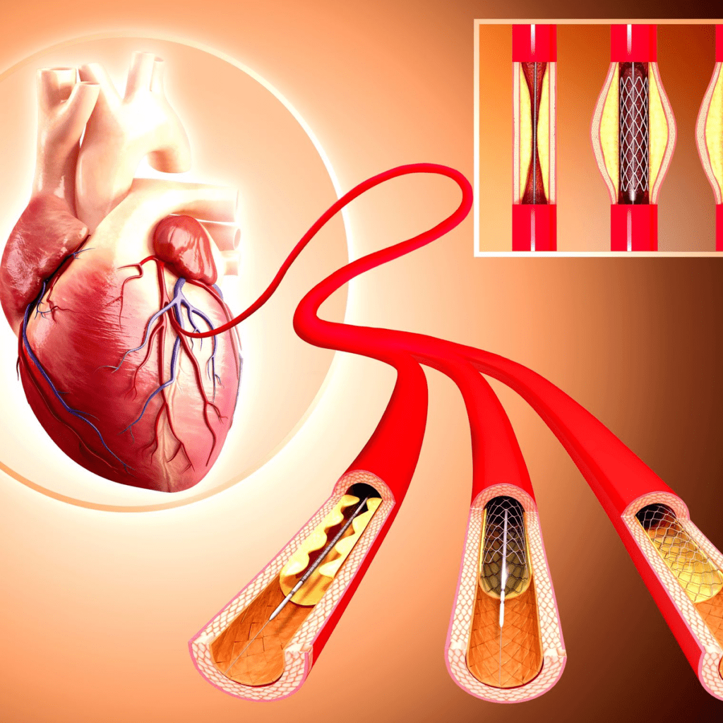 Global Coronary Stents Industry