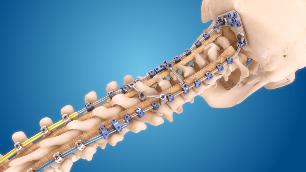 Dynamic Spinal Tethering Systems Market