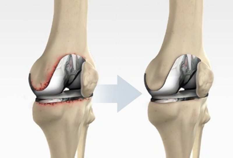 Revision Knee Replacement Market