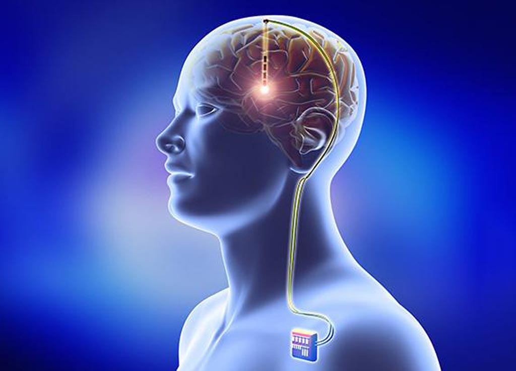 Tibial Neuromodulation Devices Market