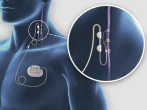 Vagus Nerve Stimulator Market