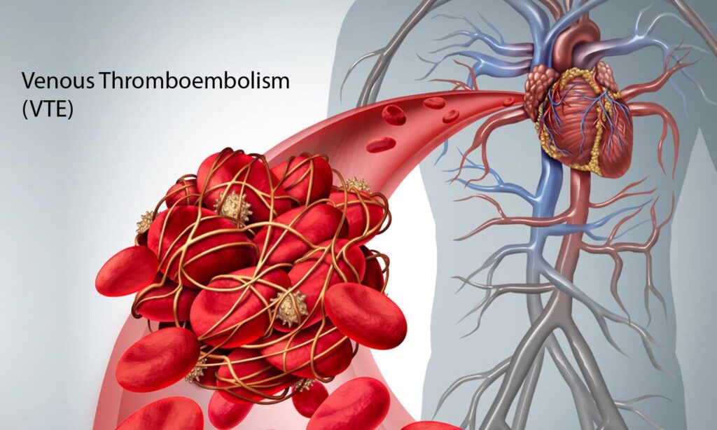 Global Venous Thromboembolism Treatment Industry