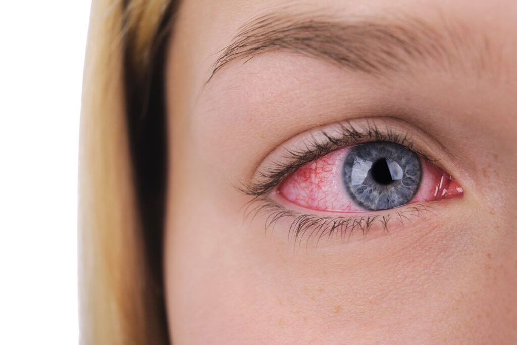 Herpes Simplex Keratitis Treatment Market