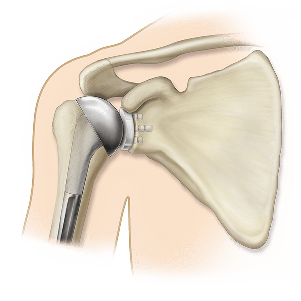 Humeral Implants Market