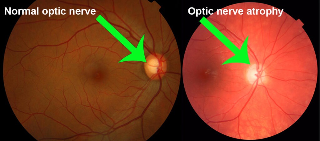 Optic Atrophy Management Market