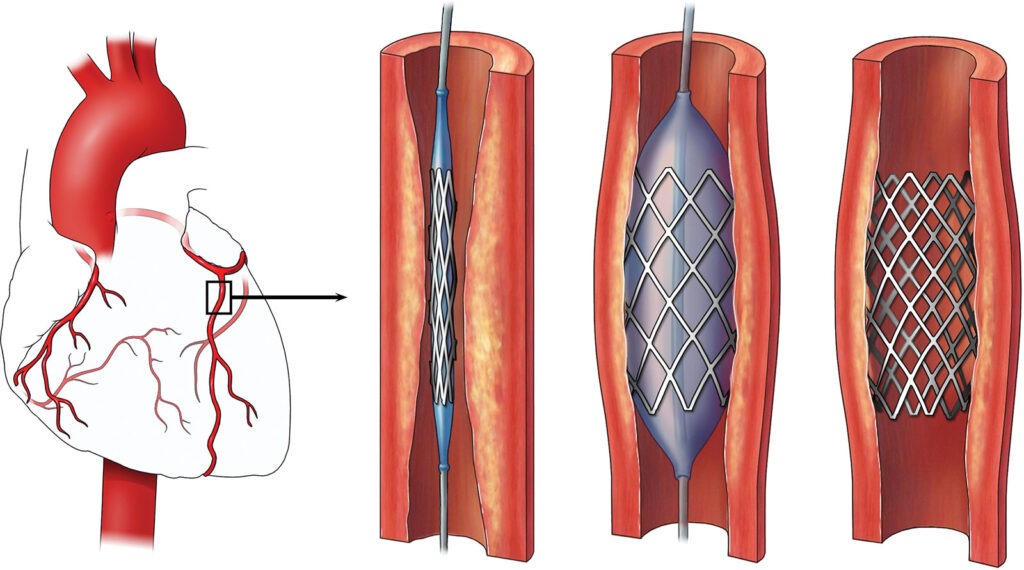 Peripheral Vascular Stent