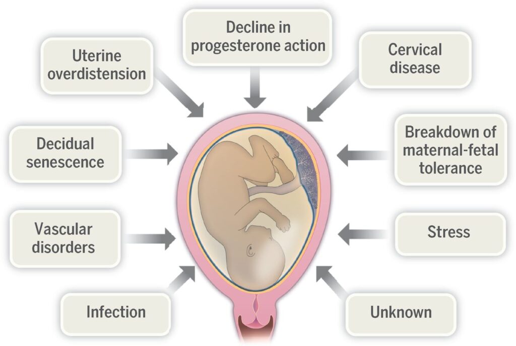  Preterm Birth Prevention and Management