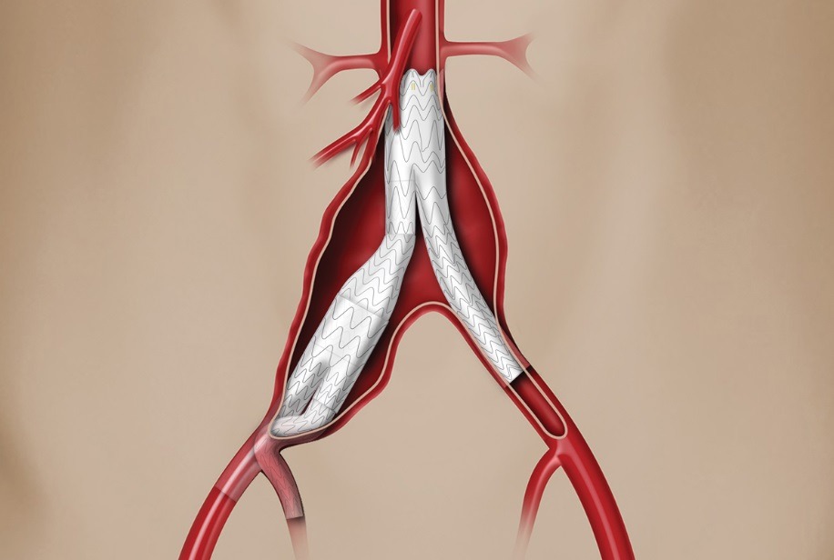 Thoracic Vascular Stent Grafts Market