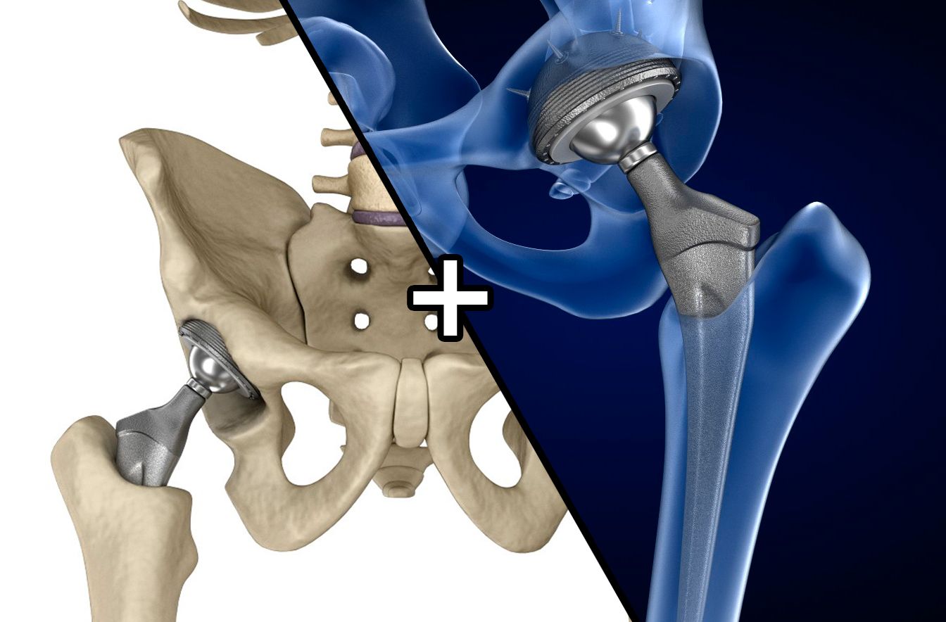 3D Printed Hip and Knee Implants Market Poised for Transformation ...