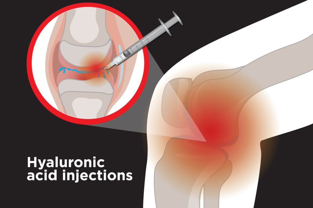 Knee Hyaluronic Acid Injections