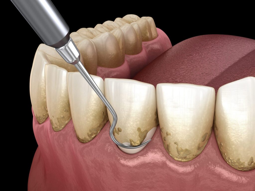 Periodontal