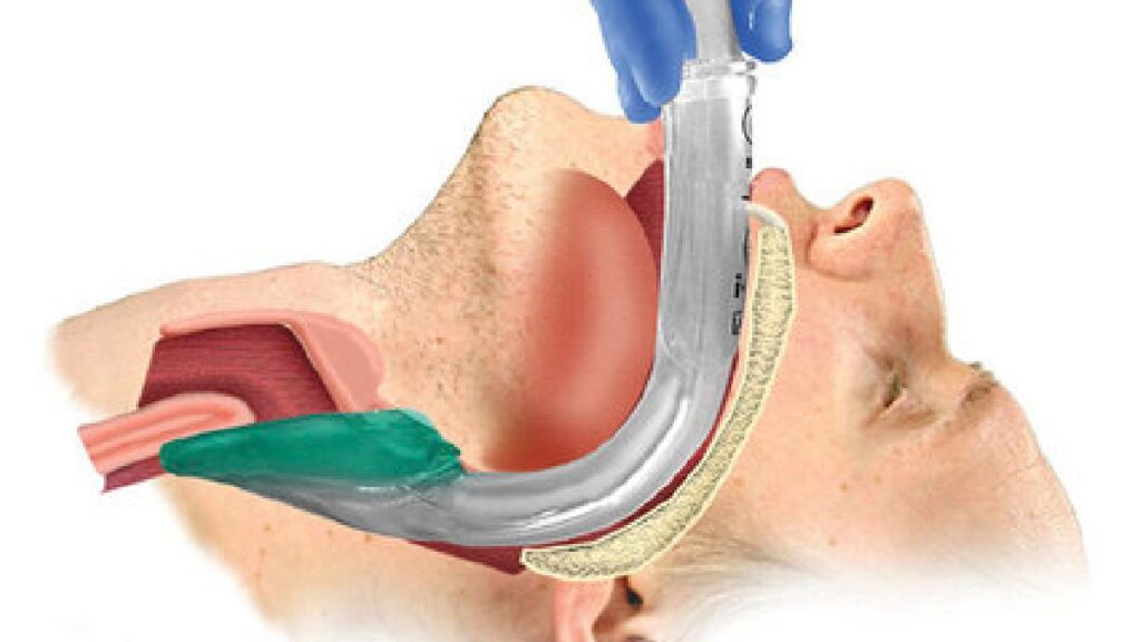 Tracheal Tubes and Airway Products Market