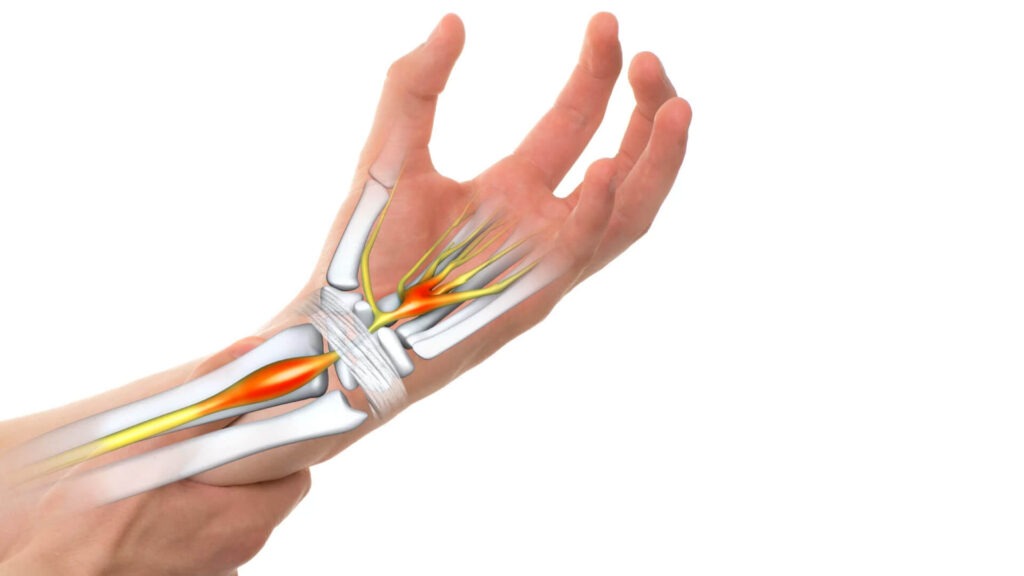 Carpal Tunnel Release Systems Market