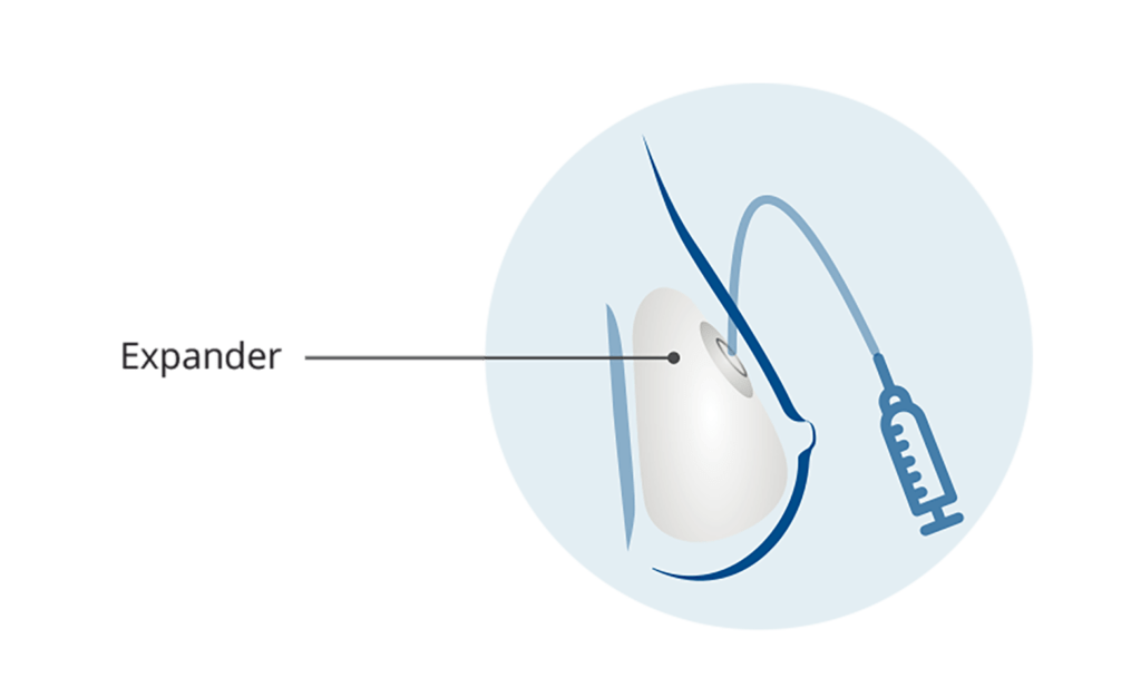 Extremity Tissue Expanders Market 