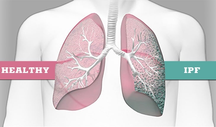 Pulmonary Fibrosis Biomarkers Market