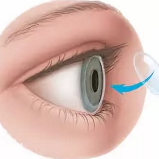 Corneal Ulcer Treatment Market