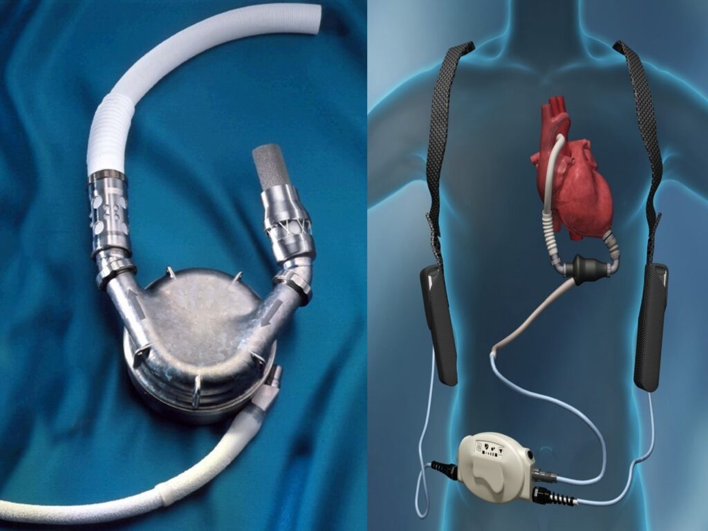 Global Cardiac Assist Devices Market