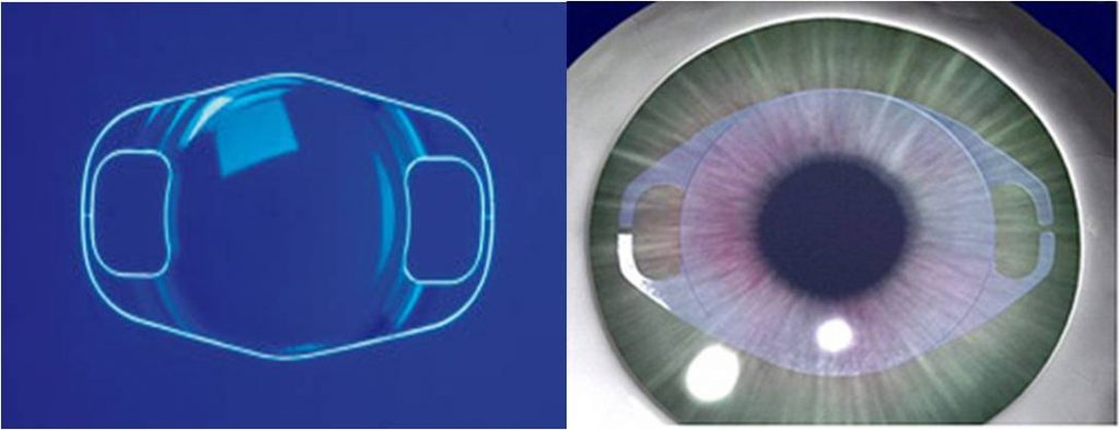 Implantable Collamer Lens (ICL) Market