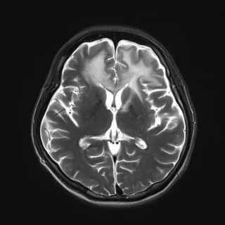 Global Progressive Multifocal Leukoencephalopathy Treatment Market