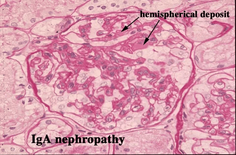 IgA Nephropathy Market