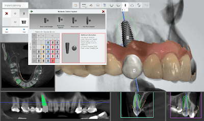 Dental Implantology Software Market