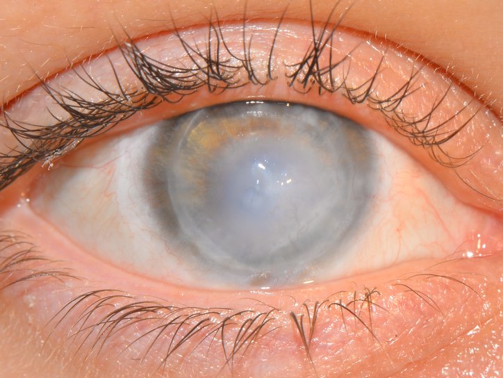 Herpes Simplex Keratitis Treatment Market