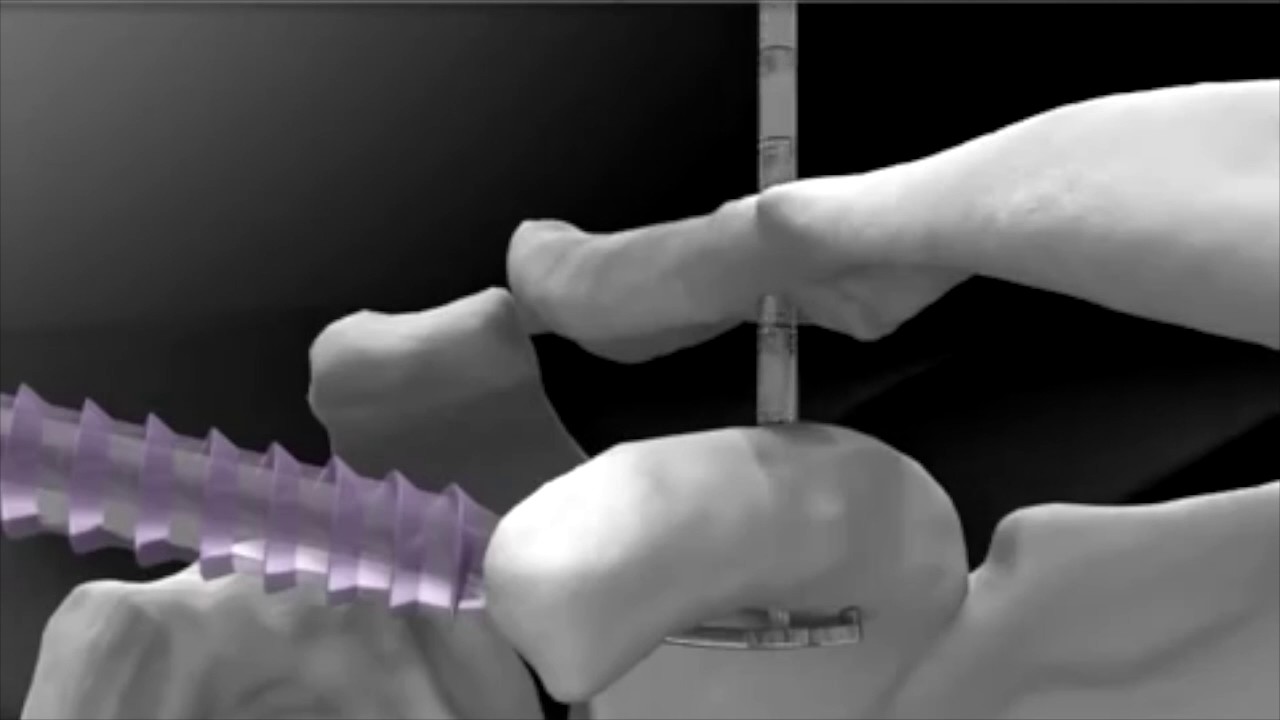 Knotless Tissue Control Devices Market Trends – Growth & Forecast 2025-2035