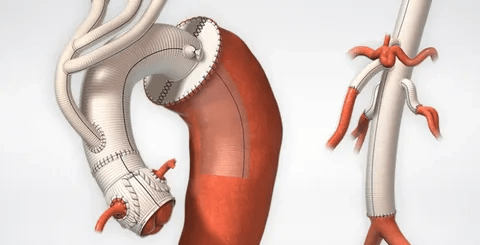 Vascular Patches Market